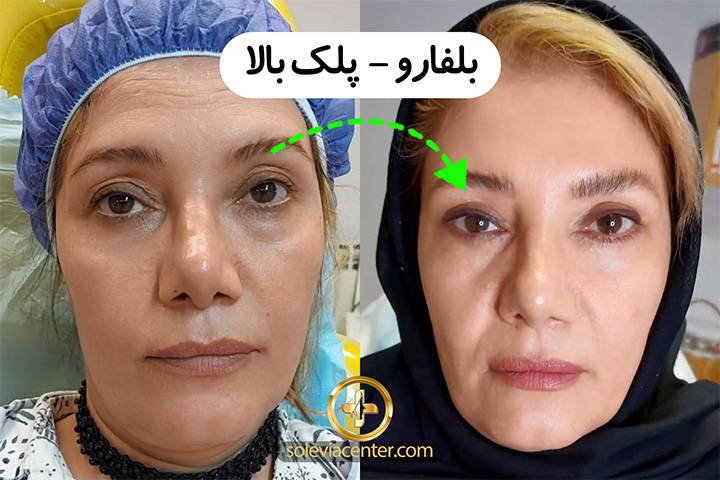 بلفارو