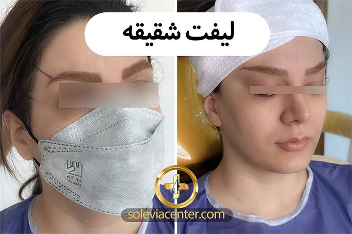 لیفت شقیقه