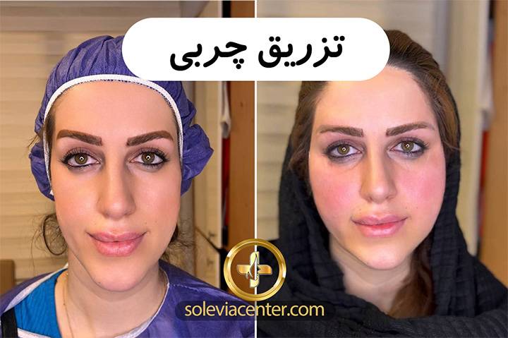 تزریق چربی
