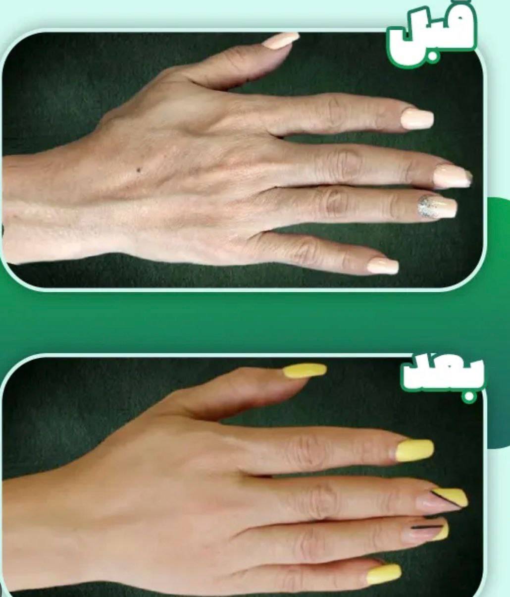 تزریق چربی